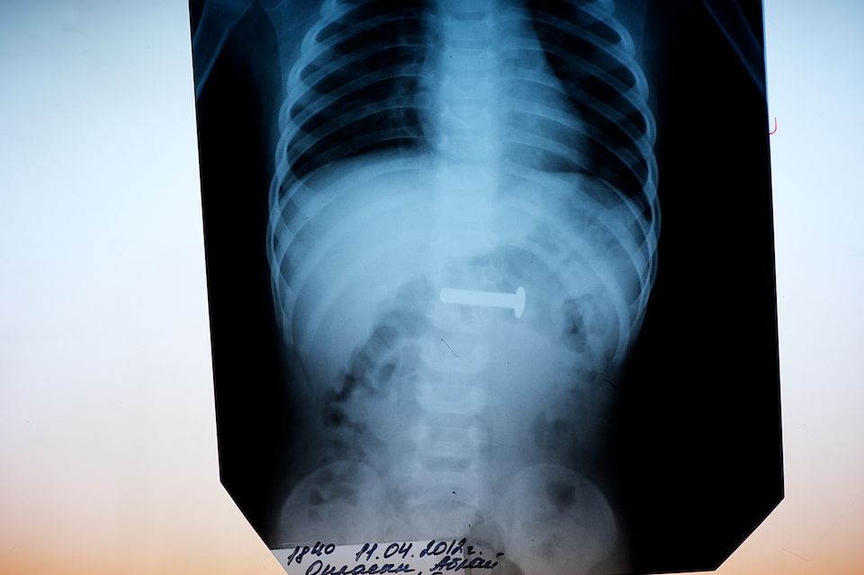 Детская хирургия Алматы: врачи спасают малышей, проглотивших инородные предметы, и предупреждают родителей об опасности повседневных вещей, детская больница, Алматы, хирургия, медицина, безопасность детей, инородные тела, врачи, дети, Карлыгаш Нуржан, Shanger.kz