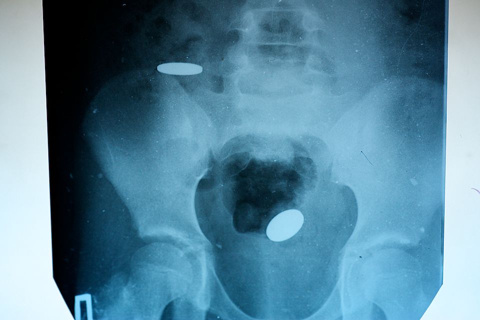 Детская хирургия Алматы: врачи спасают малышей, проглотивших инородные предметы, и предупреждают родителей об опасности повседневных вещей, детская больница, Алматы, хирургия, медицина, безопасность детей, инородные тела, врачи, дети, Карлыгаш Нуржан, Shanger.kz