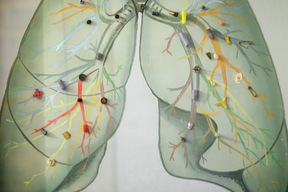 Детская хирургия Алматы: врачи спасают малышей, проглотивших инородные предметы, и предупреждают родителей об опасности повседневных вещей, детская больница, Алматы, хирургия, медицина, безопасность детей, инородные тела, врачи, дети, Карлыгаш Нуржан, Shanger.kz