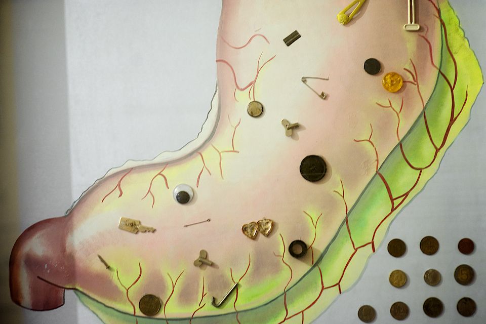 Детская хирургия Алматы: врачи спасают малышей, проглотивших инородные предметы, и предупреждают родителей об опасности повседневных вещей, детская больница, Алматы, хирургия, медицина, безопасность детей, инородные тела, врачи, дети, Карлыгаш Нуржан, Shanger.kz