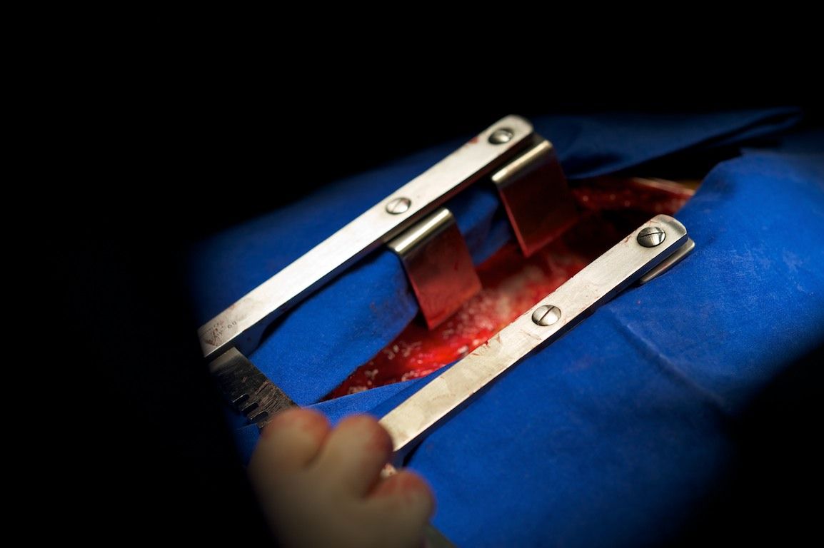 Операция на открытом сердце в клинике Almaty Sema Hospital: команда хирургов и пациент из Кыргызстана проходят сложный путь к восстановлению жизни, кардиохирургия Казахстана, Almaty Sema Hospital, операция на сердце, Казахстан, Жамалдин Болушов, Тансель Туркоглу, Феруз Бабашов, медицина, фоторепортаж, Карла Нур