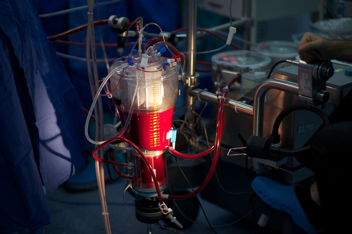 Операция на открытом сердце в клинике Almaty Sema Hospital: команда хирургов и пациент из Кыргызстана проходят сложный путь к восстановлению жизни, кардиохирургия Казахстана, Almaty Sema Hospital, операция на сердце, Казахстан, Жамалдин Болушов, Тансель Туркоглу, Феруз Бабашов, медицина, фоторепортаж, Карла Нур