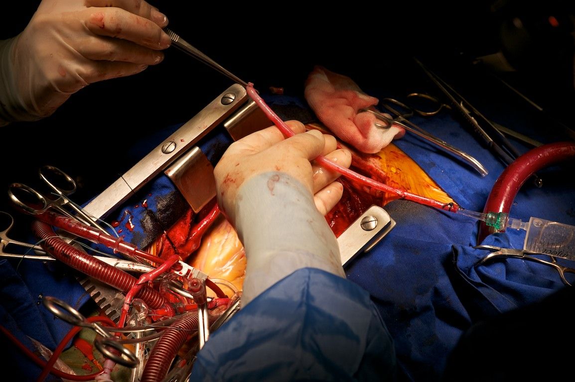 Операция на открытом сердце в клинике Almaty Sema Hospital: команда хирургов и пациент из Кыргызстана проходят сложный путь к восстановлению жизни, кардиохирургия Казахстана, Almaty Sema Hospital, операция на сердце, Казахстан, Жамалдин Болушов, Тансель Туркоглу, Феруз Бабашов, медицина, фоторепортаж, Карла Нур