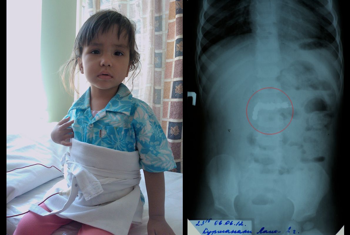 Детская хирургия Алматы: врачи спасают малышей, проглотивших инородные предметы, и предупреждают родителей об опасности повседневных вещей, детская больница, Алматы, хирургия, медицина, безопасность детей, инородные тела, врачи, дети, Карлыгаш Нуржан, Shanger.kz