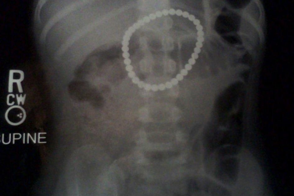 Детская хирургия Алматы: врачи спасают малышей, проглотивших инородные предметы, и предупреждают родителей об опасности повседневных вещей, детская больница, Алматы, хирургия, медицина, безопасность детей, инородные тела, врачи, дети, Карлыгаш Нуржан, Shanger.kz